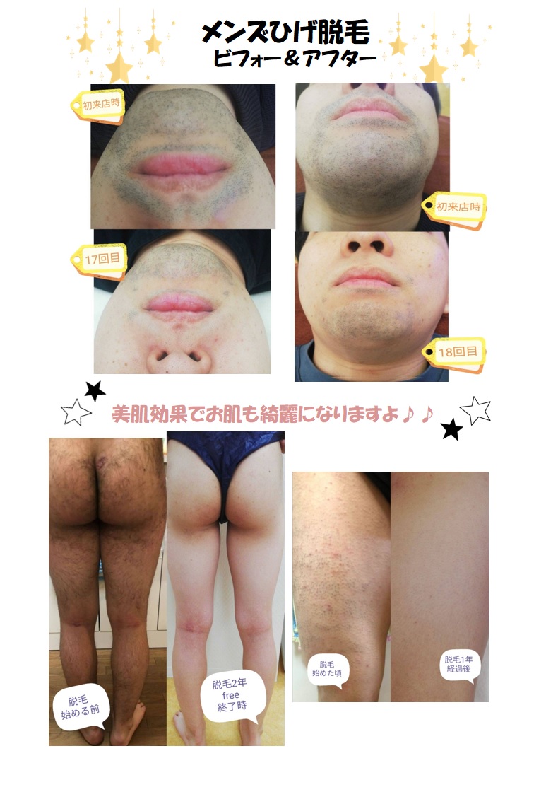 メンズひげ脱毛ビフォー＆アフター