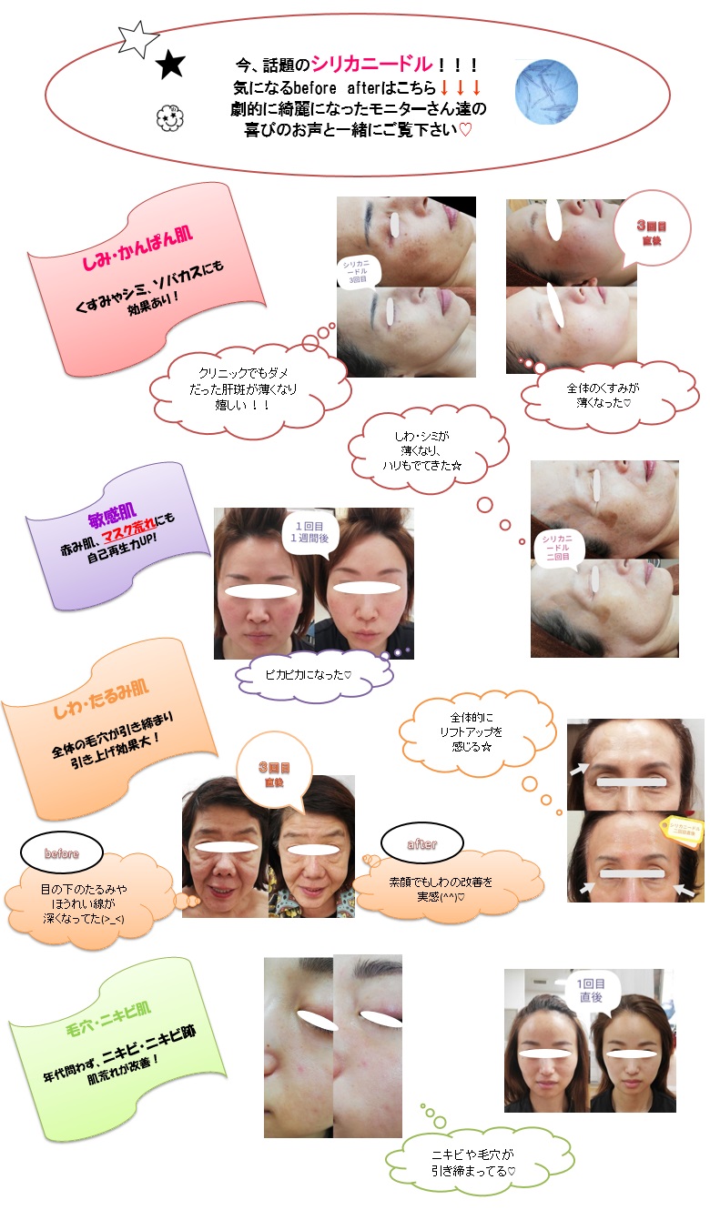 今話題のシリカニードル